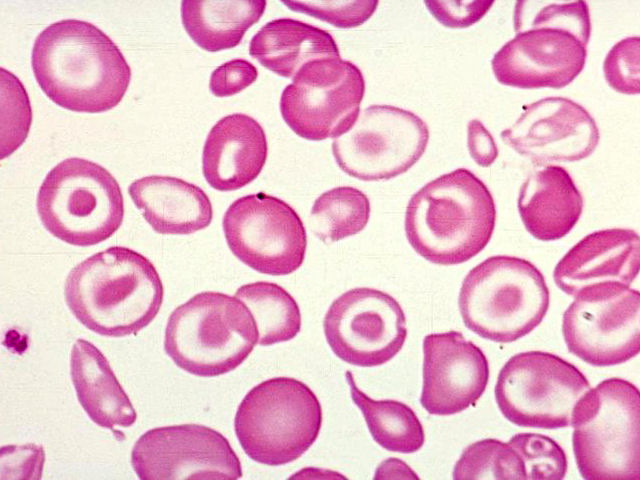 beta-talassemia